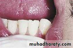 Development tooth disorders