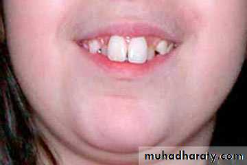 Development tooth disorders