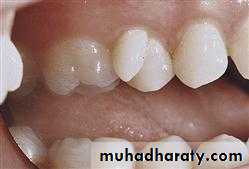 Development tooth disorders