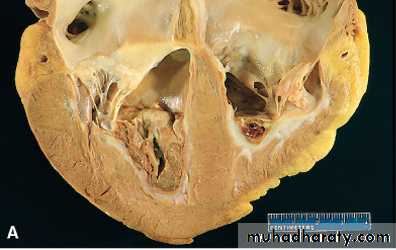 Hemodynamic disorder