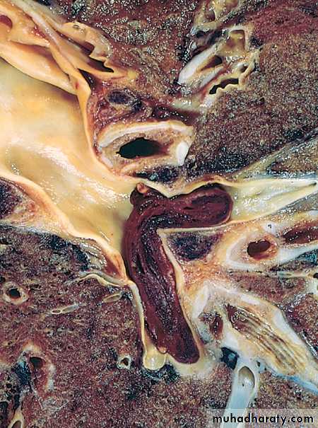 Hemodynamic disorder