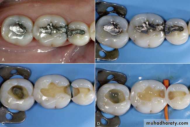 CL I Cavity_4