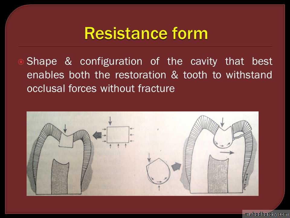 CL I Cavity_4