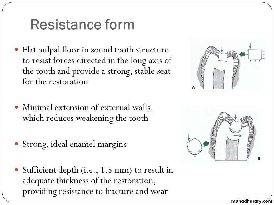 CL I Cavity_4