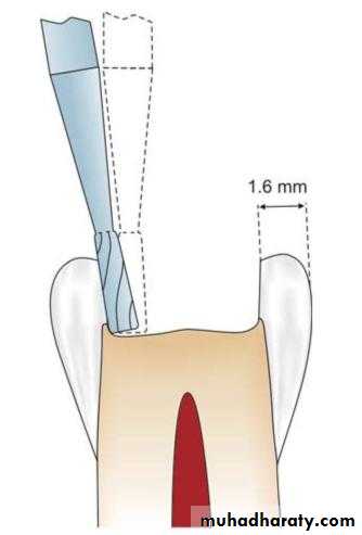 CL I Cavity_4