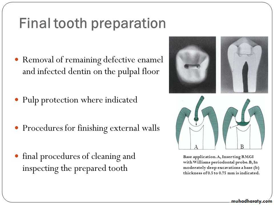 CL I Cavity_4