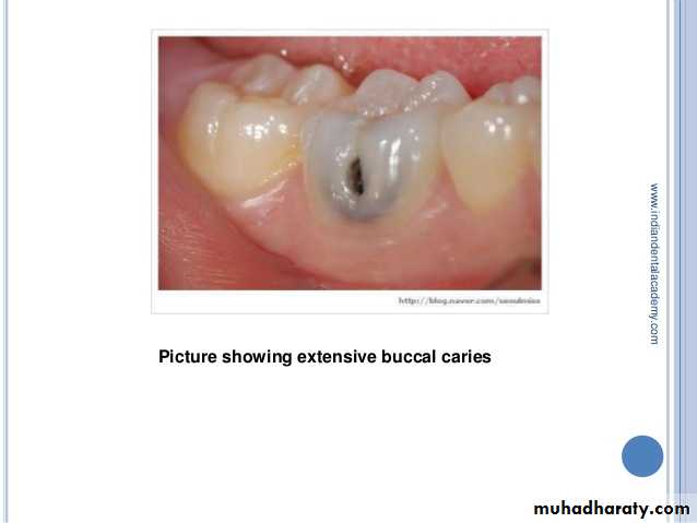 CL I Cavity_4