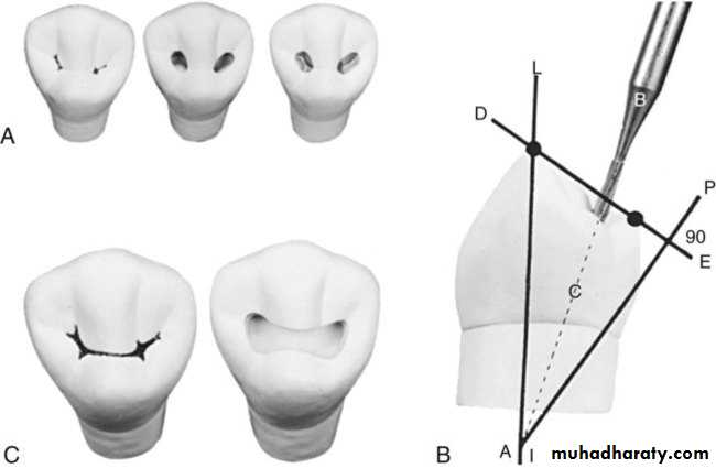 CL I Cavity_4