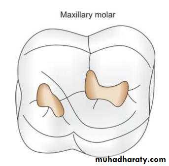 CL I Cavity_4