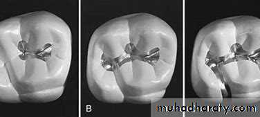 CL I Cavity_4