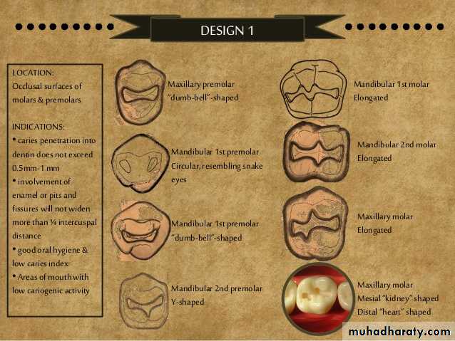 CL I Cavity_4
