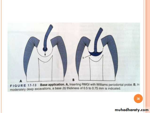 CL I Cavity_4