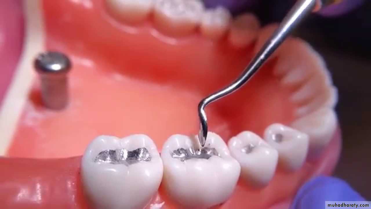 CL I Cavity_4