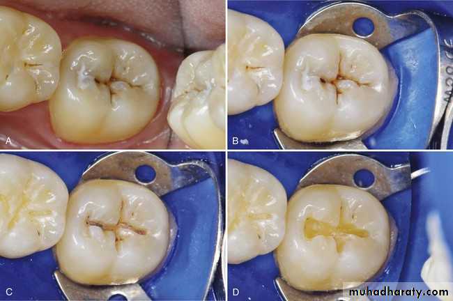 CL I Cavity_4