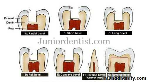 CL I Cavity_4