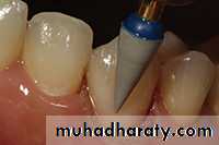 Class V Amalgam cavity _7