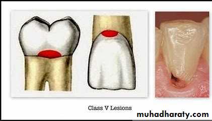 Class V Amalgam cavity _7