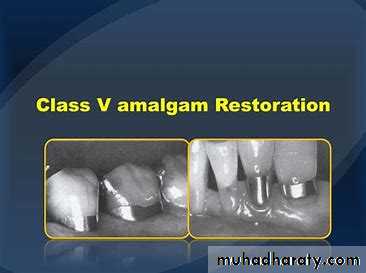 Class V Amalgam cavity _7