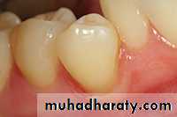 Class V Amalgam cavity _7