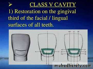 Class V Amalgam cavity _7