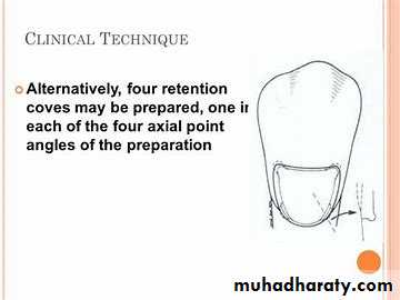Class V Amalgam cavity _7