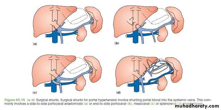 Upper GI bleeding