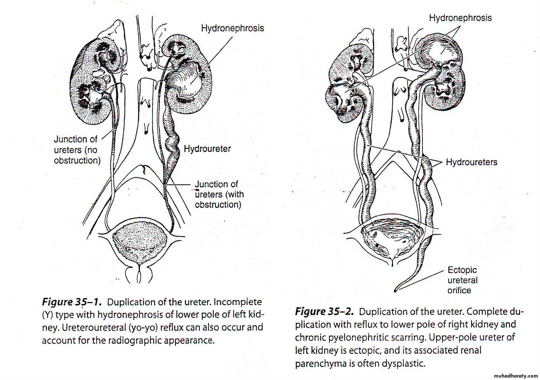 Duplication of Ureter