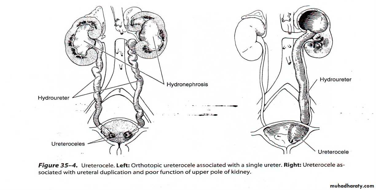 Duplication of Ureter