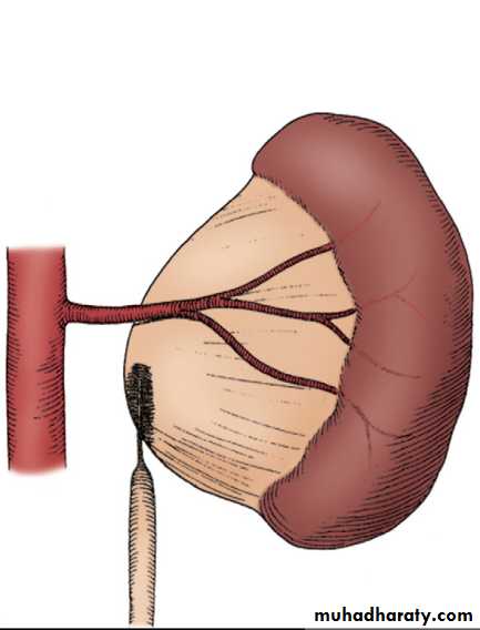 Duplication of Ureter