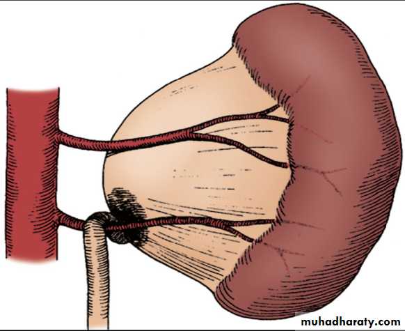 Duplication of Ureter