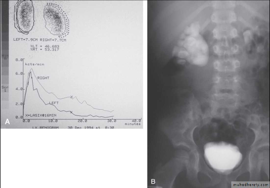 Duplication of Ureter