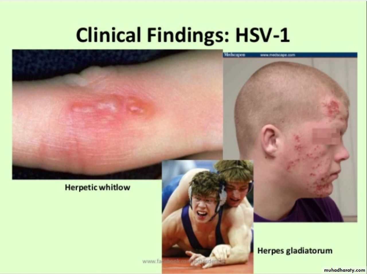 Herpesviruses