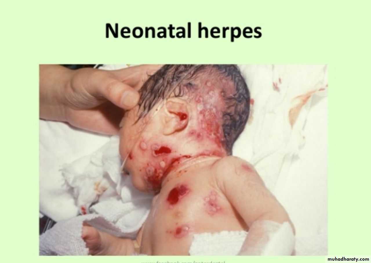 Herpesviruses