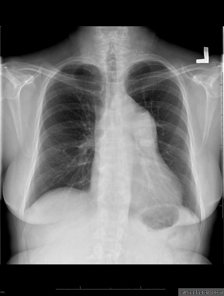 CHD