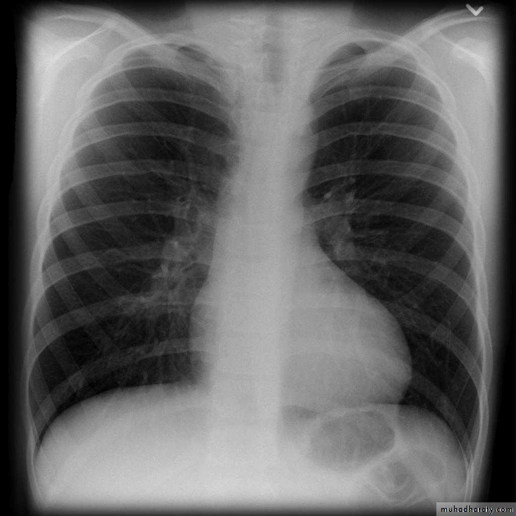 CHD