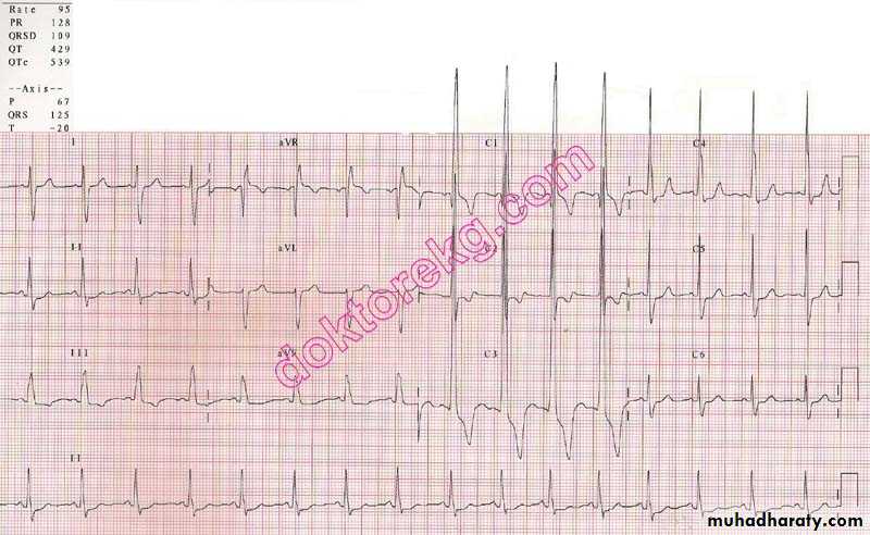 CHD