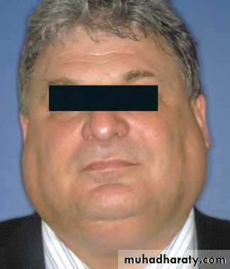 Disorders of the Salivary Glands. Part 2