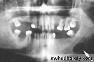 Disorders of the Salivary Glands. Part 2