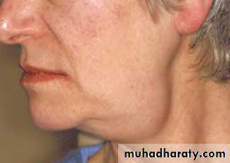 Disorders of the Salivary Glands. Part 2
