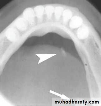 Disorders of the Salivary Glands. Part 2