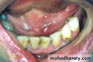 Disorders of the Salivary Glands. Part 2