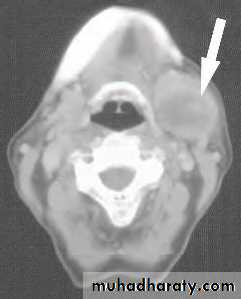 Disorders of the Salivary Glands. Part 2