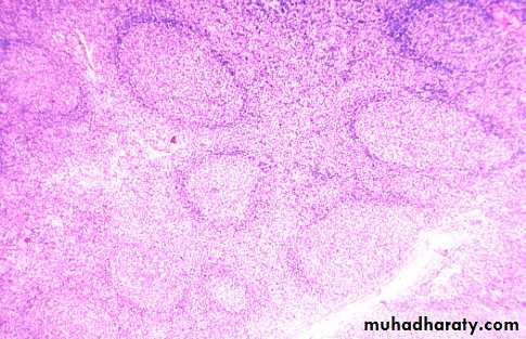 Pathology of lymph nodes
