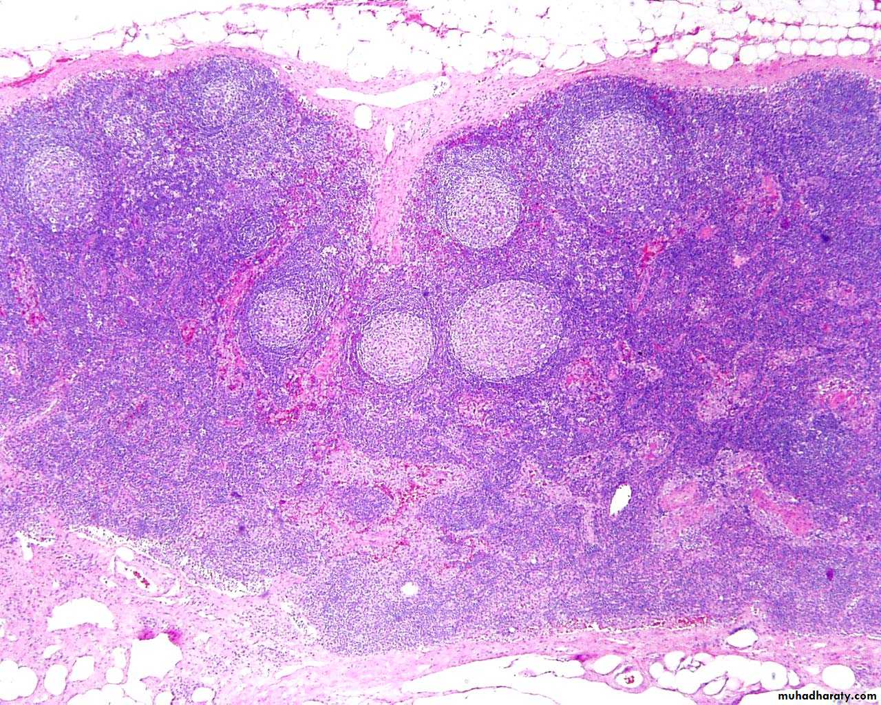 Pathology of lymph nodes