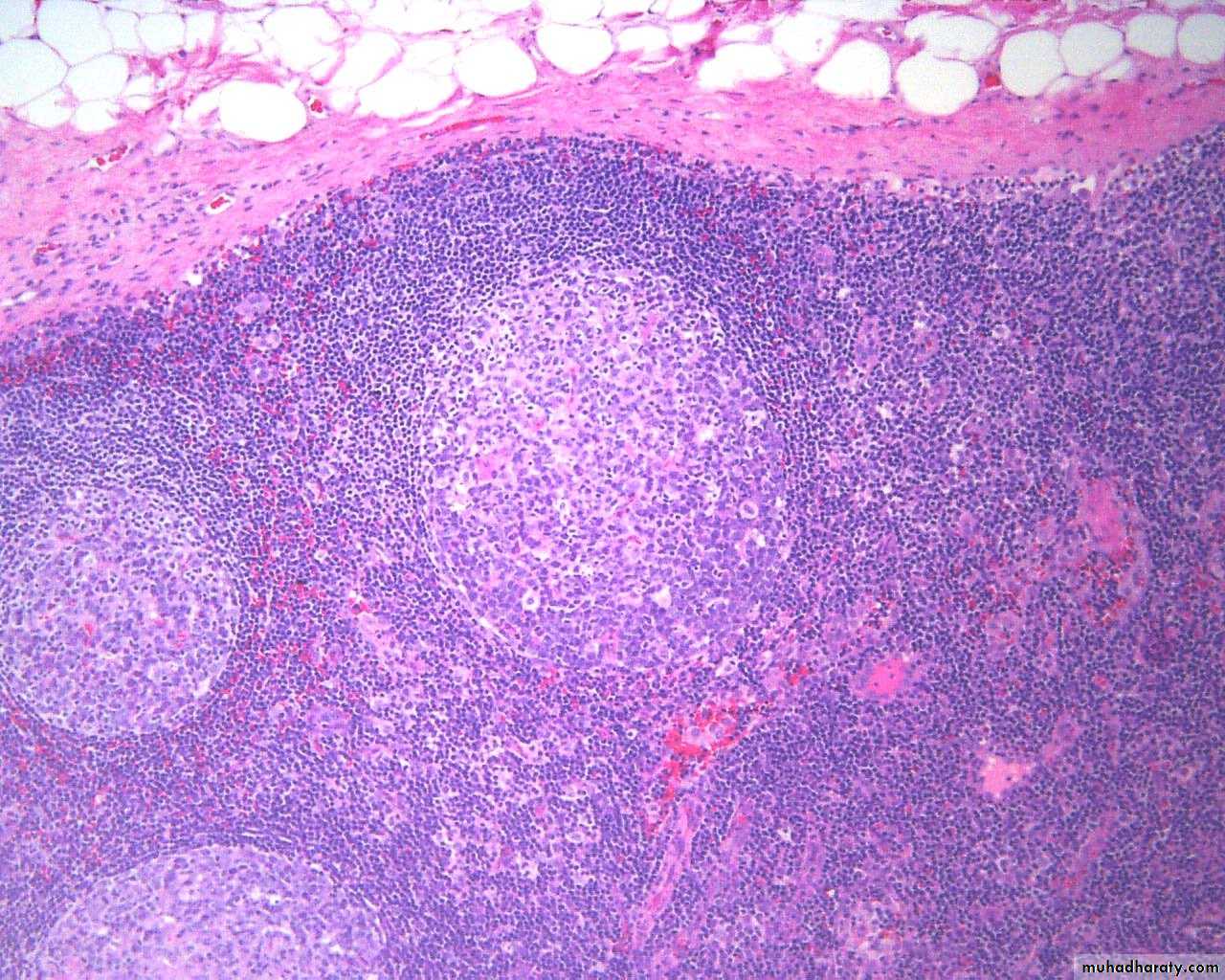 Pathology of lymph nodes