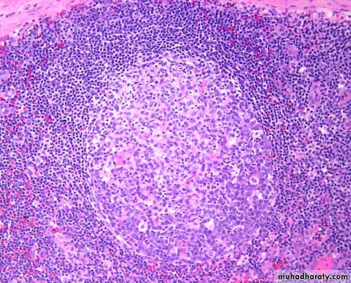 Pathology of lymph nodes