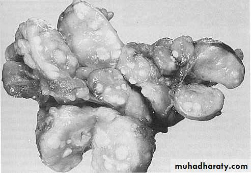 Pathology of lymph nodes