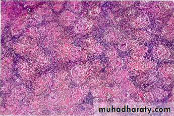 Pathology of lymph nodes
