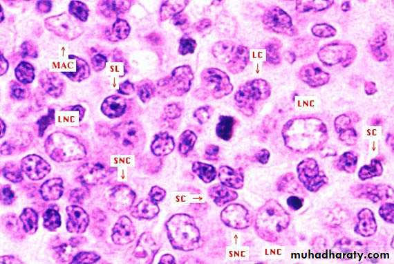 Pathology of lymph nodes