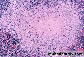 Pathology of lymph nodes